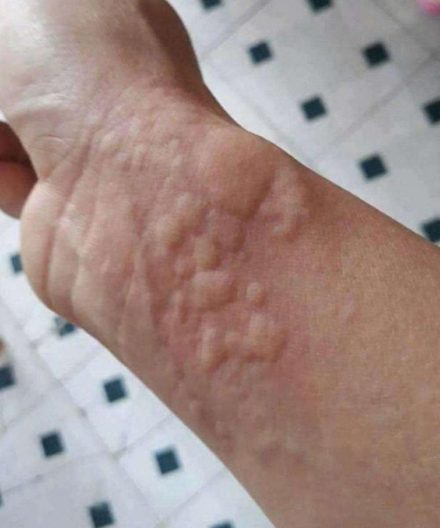 When Hives and Breathing Changes Appear Together